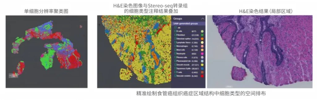 伴导管分化食管癌 H&E 染色图像与 Stereo-seq FF 转录组数据叠加，显示肿瘤位于食管黏膜鳞状上皮下、呈小管样